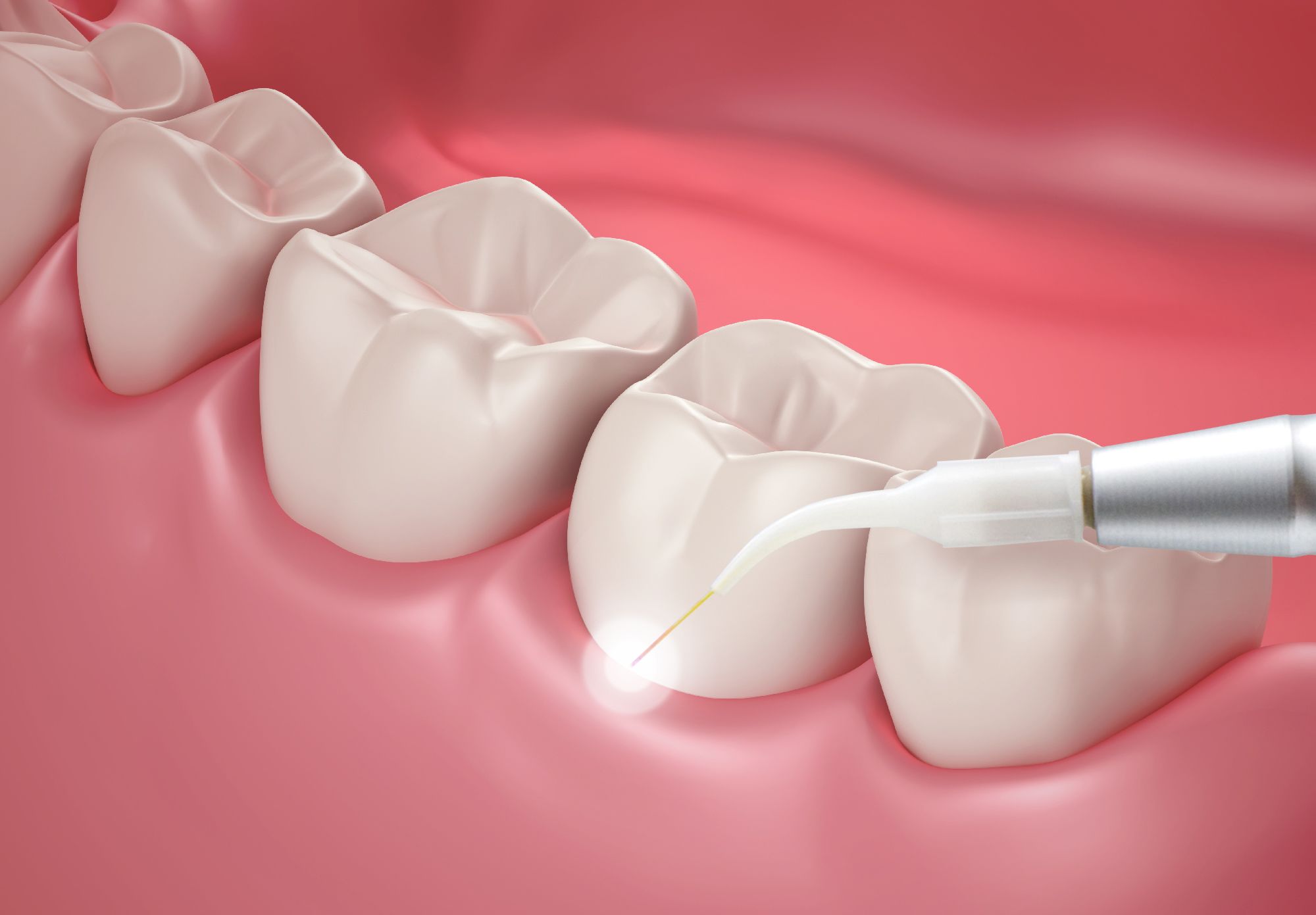 dental laser