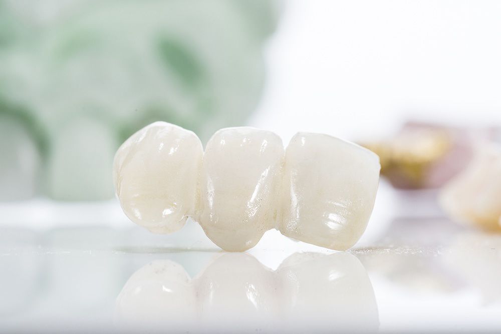 Dental bridge