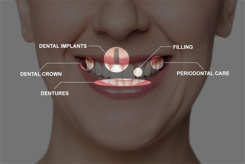 image of full mouth reconstruction