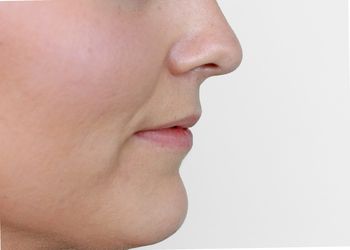 patient before Juvederm filler in lips
