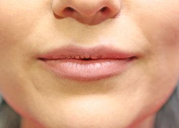 patient after Juvederm filler in lips